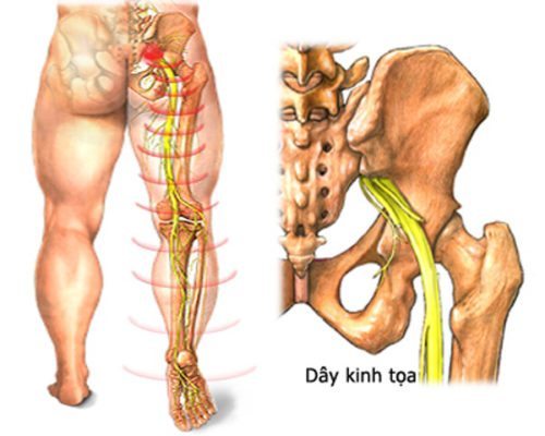 Chữa đau thần kinh tọa bằng Đông y